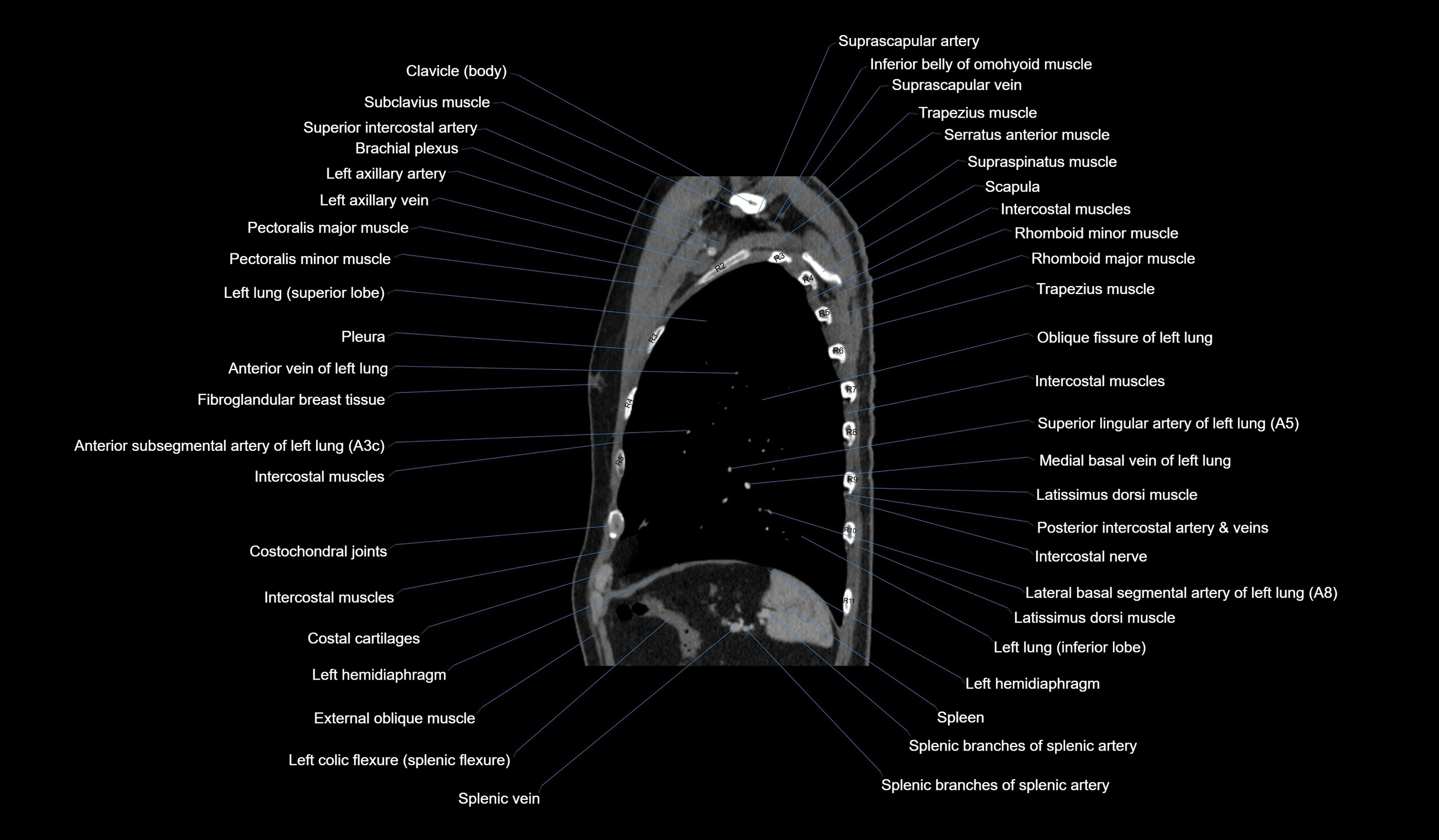 CT chest (thorax) soft tissue window labelled sagittal cross sectional anatomy radiology image-00111.webp